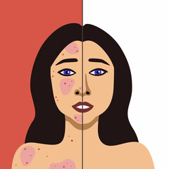 Vector image of European woman before and after acne skin treatment minimalistic illustration