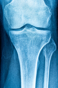 x-ray image of knee AP view for detect Osteoarthritis Knee