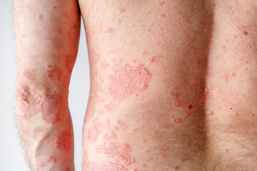 Papules of chronic psoriasis vulgaris on male arm and back body on neutral background. Genetic immune disease.