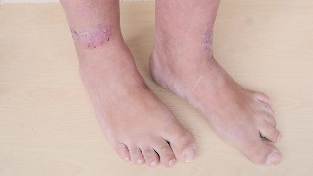 rash, hives, itchy skin on legs, inflammation and Medical Allergies, disease on body of female patient, Dermatology Skin Issues, health care, skin problems on general physical and emotional well-being