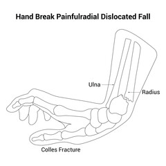 Hand Break Painfulradial Dislocated Fall Science Design Vector Illustration