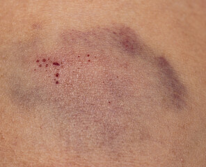 Fototapeta premium blue bruise on the skin of the arm.