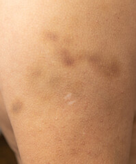 blue bruise on the skin of the arm.