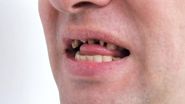 Periodontal disease, loose teeth in toothless man mouth, close up. Dental problems and orthodontic treatment for patient.