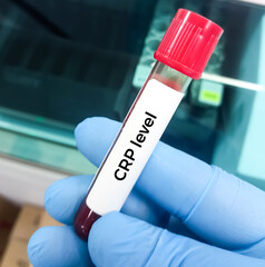 Blood sample for CRP(C-reactive protein) test used to identify inflammation or infection in the...