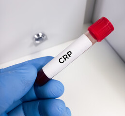 Blood sample for CRP(C-reactive protein) test used to identify inflammation or infection in the...