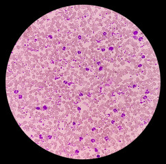 Essential thrombocytosis blood smear showing abnormal high volume of platelet and White Blood...
