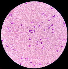 Essential thrombocytosis blood smear showing abnormal high volume of platelet and White Blood...