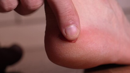 Calluses and corns, men's feet, consequences wearing uncomfortable shoes. Man rubs large place on his foot with his hand. Blister on barefoot female heel. Close-up. Painful dry callus on skin feet.