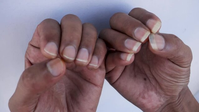 Macro shot of untrimmed nails on an Indian adult's hand. Body hygiene awareness concept