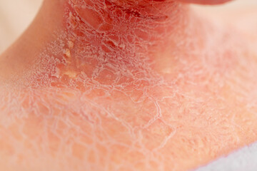 close-up of inflamed red crusted skin dermatology desquamation disease - obrazy, fototapety, plakaty