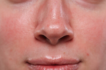 Closeup view of woman with reddened skin