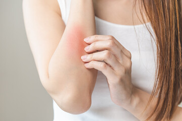Dermatology asian young woman, girl allergy, allergic reaction from atopic, insect bites on her arm, hand in scratching itchy, itch red spot or rash of skin. Healthcare, treatment of beauty.