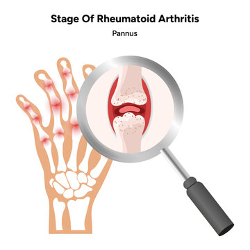 Medical infographic stage of rheumatoid arthritis joints pannus