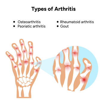 Medical illustration and information types of arthritis 
