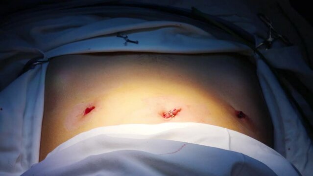view of hands of doctors which impose clips after endoscopy operation