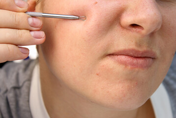 Close up of caucasian woman's face with scars, acne skin problems