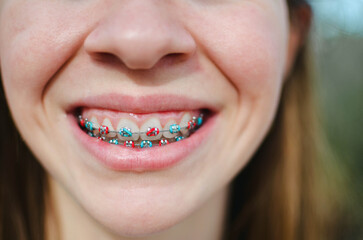 Close up of a smiling teen girl with orthodontic braces