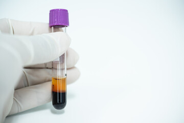 Doctor hand wearing white glove holding blood test tube for coronavirus (COVID-19) diagnosis on white background.Technician and blood test tube at lalaboratory unit.