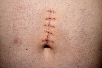 A medical suture on a mans stomach.