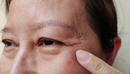 close up of the fingers holding the flabbiness and wrinkle beside the eyelid, dark spots and blemish on the face of the woman, health care and beauty concept.