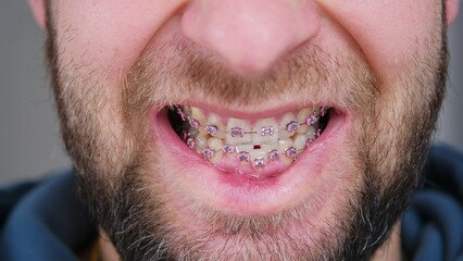 Adult Caucasian Male with Serious Malocclusion of Chipped and Damaged Teeth with Metal Dental Braces For Orthodontic Treatment