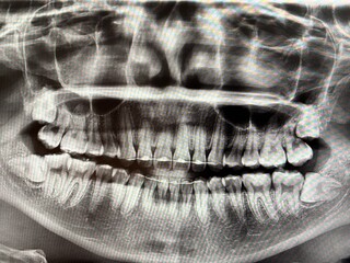 X-ray image of dental wisdom teeth