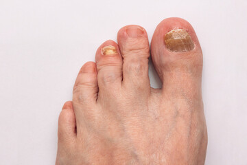 close-up photo of toenails affected by a fungal disease. Onychomycosis. Podology