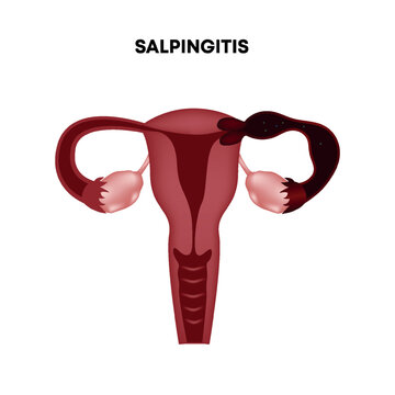 Salpingitis, inflammation of the fallopian tube. Female reproductive system. Vector illustration