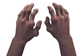 Gout-afflicted hands with deformities, 3D illustration - obrazy, fototapety, plakaty