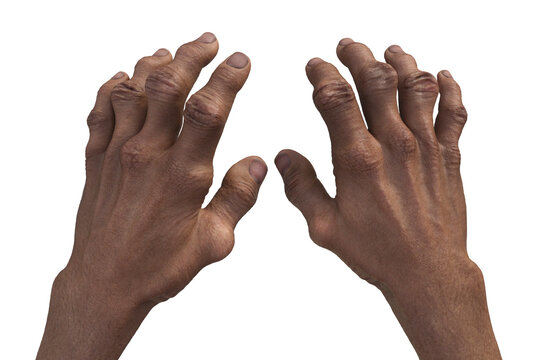 Gout-afflicted hands with deformities, 3D illustration