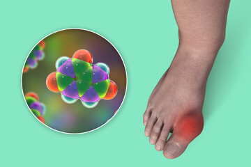 Gout-afflicted foot, 3D illustration