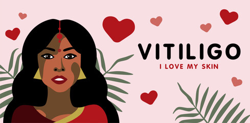Banner about vitilingo skin disease with young beautiful Indian woman minimalistic vector