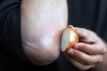 Natural Alternative Remedial for Bee Puncture is To Apply a Cut Onion on the Puncture to Absorb the...