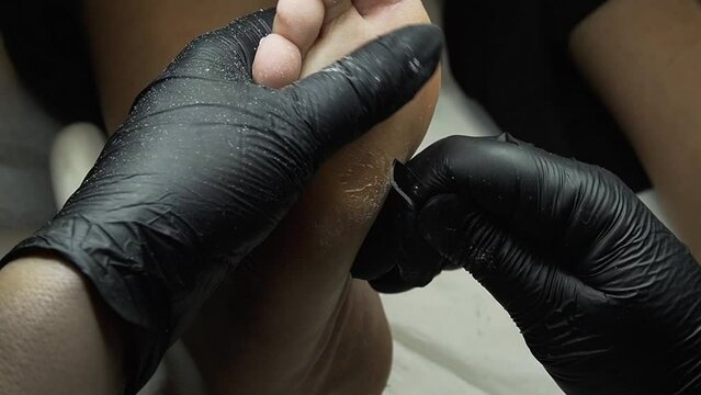 Close up hand chiropodist peeling off skin with sharp scalpel wearing black gloves..