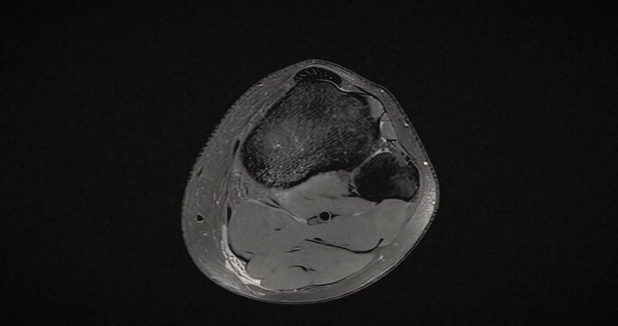 Grungy and highly textured vintage MRI scan of an injured male knee, after excess basketball playing. Scanning top to bottom.