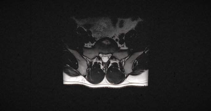 Grungy and highly textured vintage MRI scan of male lumbar spine with a herniated disc due to excess weightlifting training. Scanning from top to bottom