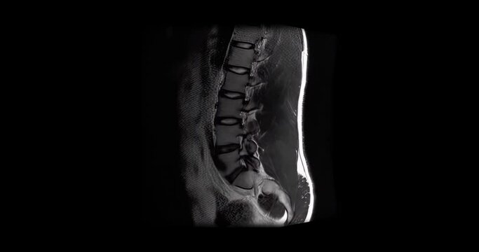MRI scan of a male lumbar spine exhibiting a lightly herniated disc, scanning from side to side