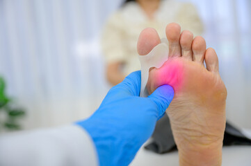 A doctor orthopedist examining leg with Hallux Valgus deformity on the first toe. Foot treatment with the orthopedic unit treats pain caused by uncomfortable shoes - obrazy, fototapety, plakaty