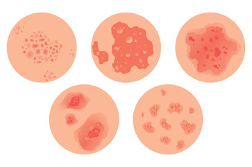 Different types of psoriasis vector set. Part of patients skin with dermatitis, inflammation, red rash and other skin problems. Cartoon illustration for disease concept