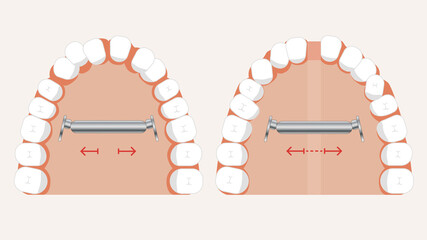 widen upper jaw © Nena