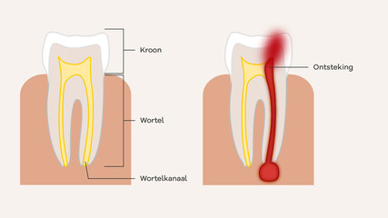 Tooth root inflammation