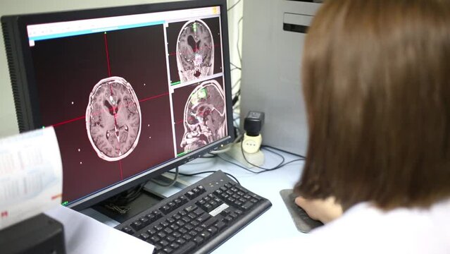 The doctor looks at the pictures of a brain tumor on the monitor