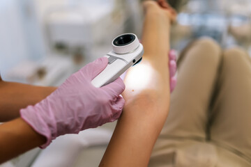 The dermatologist examines the moles or acne of the patient with a dermatoscope. Prevention of...
