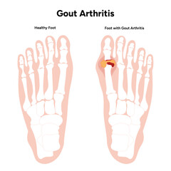 Medical illustration gout arthritis foot and health foot