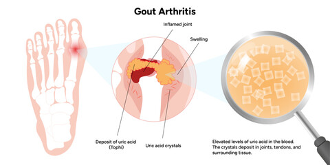 Medical infographic and information gout arthritis in the foot 