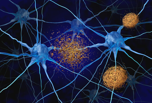 Amyloid Targeted Therapy as plaques made of abnormal clusters of protein fragments being that accumulate between nerve cells destroyed or dissolved as a tretment to halt or slow down brain degenerativ