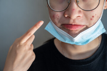Cropped shot view of woman open her mask and pointing acne problem occur on her skin caused of...