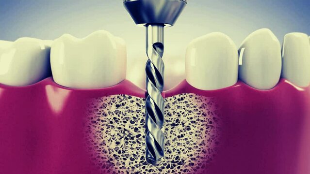 Dental implant instalation, custom abutment and ceramic crown. Medically accurate tooth 3D animation