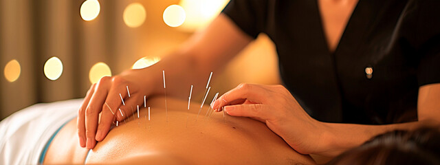 Acupuncture in a spa salon. Selective focus. - obrazy, fototapety, plakaty